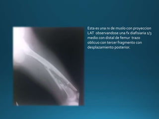Esta es una rx de muslo con proyeccion
LAT observandose una fx diafisiaria 1/3
medio con distal de femur trazo
oblicuo con tercer fragmento con
desplazamiento posterior.
 