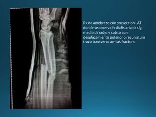 Rx de antebrazo con proyeccion LAT
donde se observa fx diafisiaria de 1/3
medio de radio y cubito con
desplazamiento poterior o recurvatum
trazo transverso ambas fractura
 