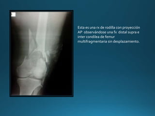 Esta es una rx de rodilla con proyección
AP observándose una fx distal supra e
inter condilea de femur
multifragmentaria sin desplazamiento.
 