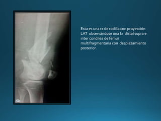 Esta es una rx de rodilla con proyección
LAT observándose una fx distal supra e
inter condilea de femur
multifragmentaria con desplazamiento
posterior.
 