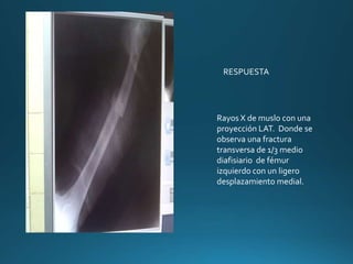 RESPUESTA
Rayos X de muslo con una
proyección LAT. Donde se
observa una fractura
transversa de 1/3 medio
diafisiario de fémur
izquierdo con un ligero
desplazamiento medial.
 