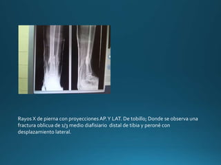 Rayos X de pierna con proyeccionesAP.Y LAT. De tobillo; Donde se observa una
fractura oblicua de 1/3 medio diafisiario distal de tibia y peroné con
desplazamiento lateral.
 