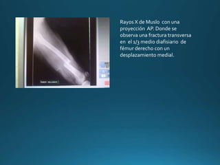 Rayos X de Muslo con una
proyección AP. Donde se
observa una fractura transversa
en el 1/3 medio diafisiario de
fémur derecho con un
desplazamiento medial.
 