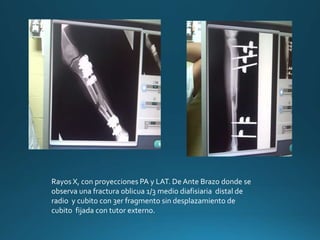 Rayos X, con proyecciones PA y LAT. De Ante Brazo donde se
observa una fractura oblicua 1/3 medio diafisiaria distal de
radio y cubito con 3er fragmento sin desplazamiento de
cubito fijada con tutor externo.
 