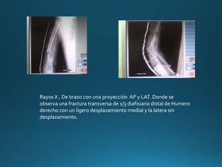Rayos X , De brazo con una proyección AP y LAT. Donde se
observa una fractura transversa de 1/3 diafisiario distal de Humero
derecho con un ligero desplazamiento medial y la latera sin
desplazamiento.
 