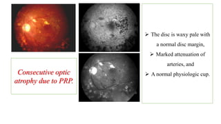 Consecutive optic
atrophy due to PRP.
 The disc is waxy pale with
a normal disc margin,
 Marked attenuation of
arteries, and
 A normal physiologic cup.
 