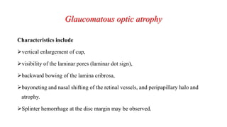Glaucomatous optic atrophy
Characteristics include
vertical enlargement of cup,
visibility of the laminar pores (laminar dot sign),
backward bowing of the lamina cribrosa,
bayoneting and nasal shifting of the retinal vessels, and peripapillary halo and
atrophy.
Splinter hemorrhage at the disc margin may be observed.
 