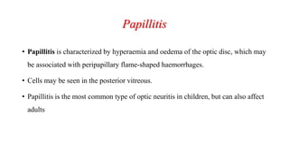 Papillitis
• Papillitis is characterized by hyperaemia and oedema of the optic disc, which may
be associated with peripapillary flame-shaped haemorrhages.
• Cells may be seen in the posterior vitreous.
• Papillitis is the most common type of optic neuritis in children, but can also affect
adults
 
