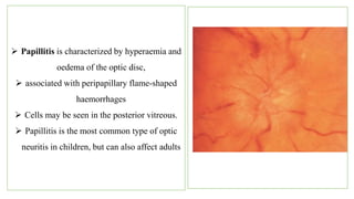  Papillitis is characterized by hyperaemia and
oedema of the optic disc,
 associated with peripapillary flame-shaped
haemorrhages
 Cells may be seen in the posterior vitreous.
 Papillitis is the most common type of optic
neuritis in children, but can also affect adults
 