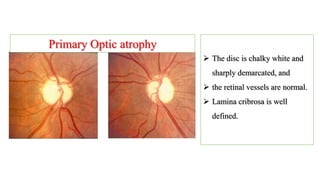 Primary Optic atrophy
 The disc is chalky white and
sharply demarcated, and
 the retinal vessels are normal.
 Lamina cribrosa is well
defined.
 