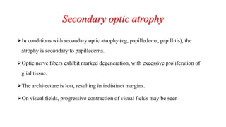 Secondary optic atrophy
In conditions with secondary optic atrophy (eg, papilledema, papillitis), the
atrophy is secondary to papilledema.
Optic nerve fibers exhibit marked degeneration, with excessive proliferation of
glial tissue.
The architecture is lost, resulting in indistinct margins.
On visual fields, progressive contraction of visual fields may be seen
 