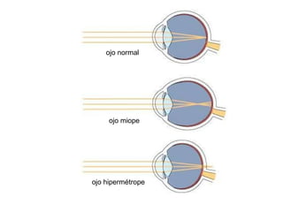 ojo normal




     ojo miope




ojo hipermétrope
 