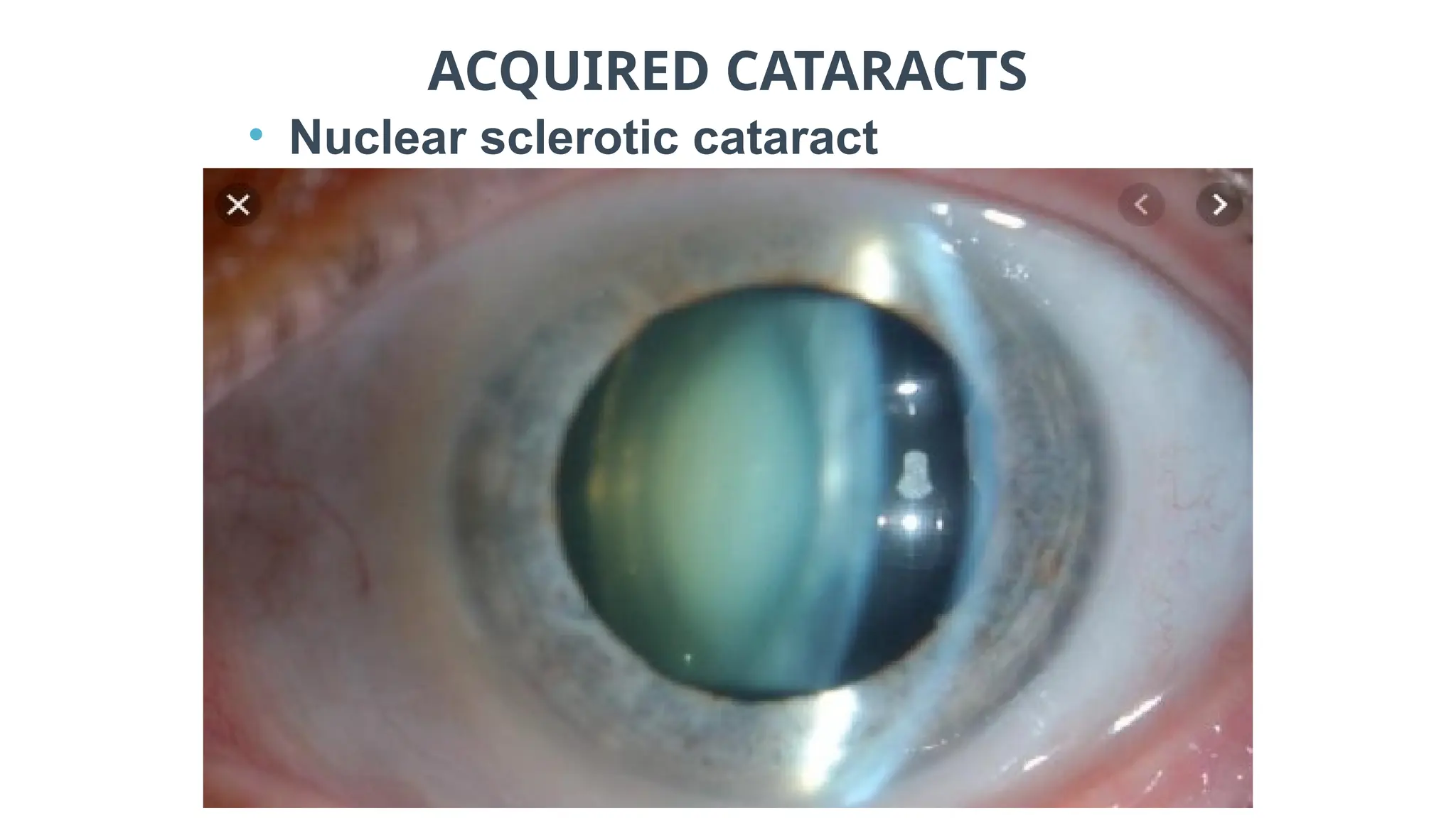 ACQUIRED CATARACTS
• Nuclear sclerotic cataract
 