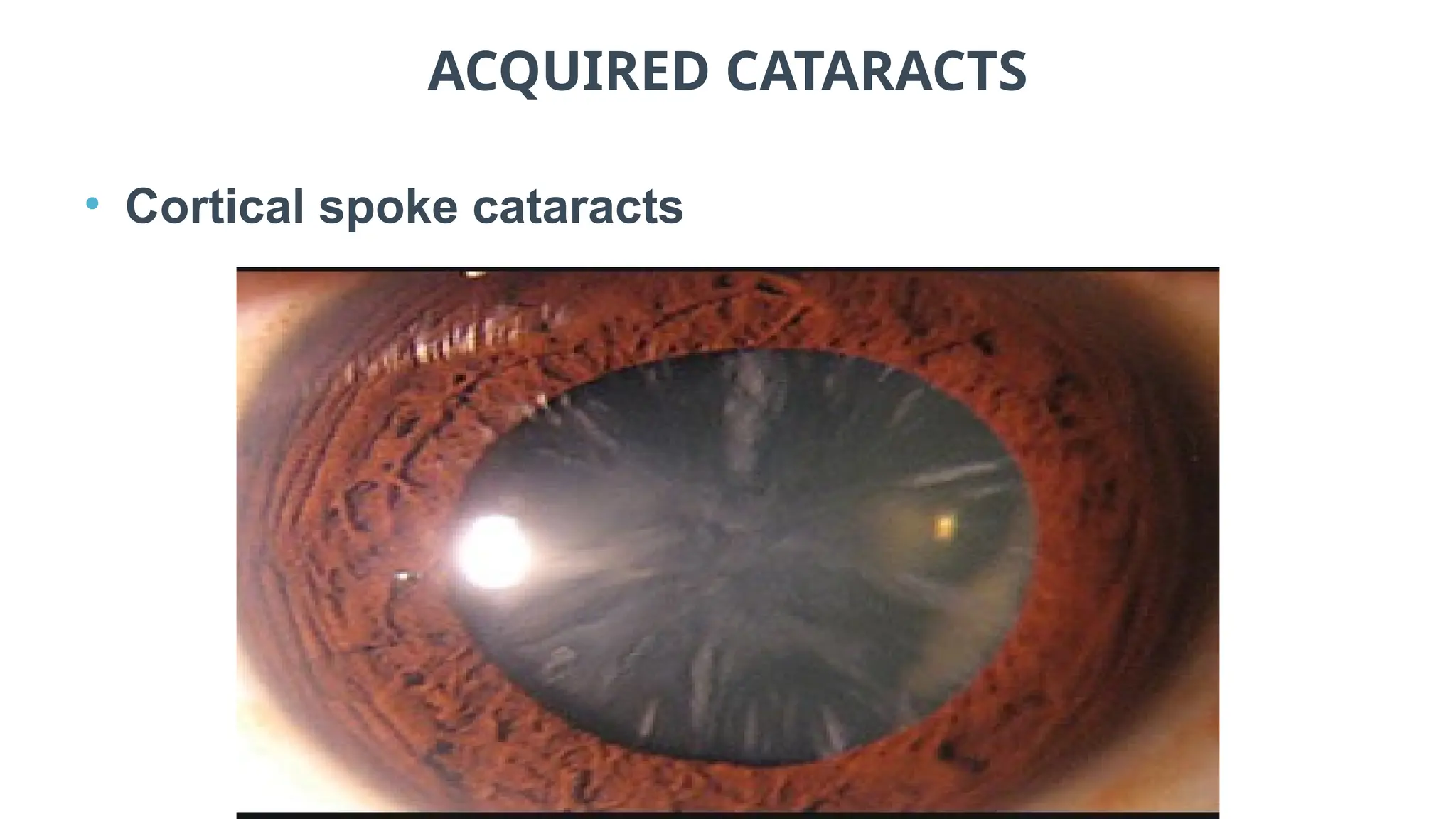 ACQUIRED CATARACTS
• Cortical spoke cataracts
 