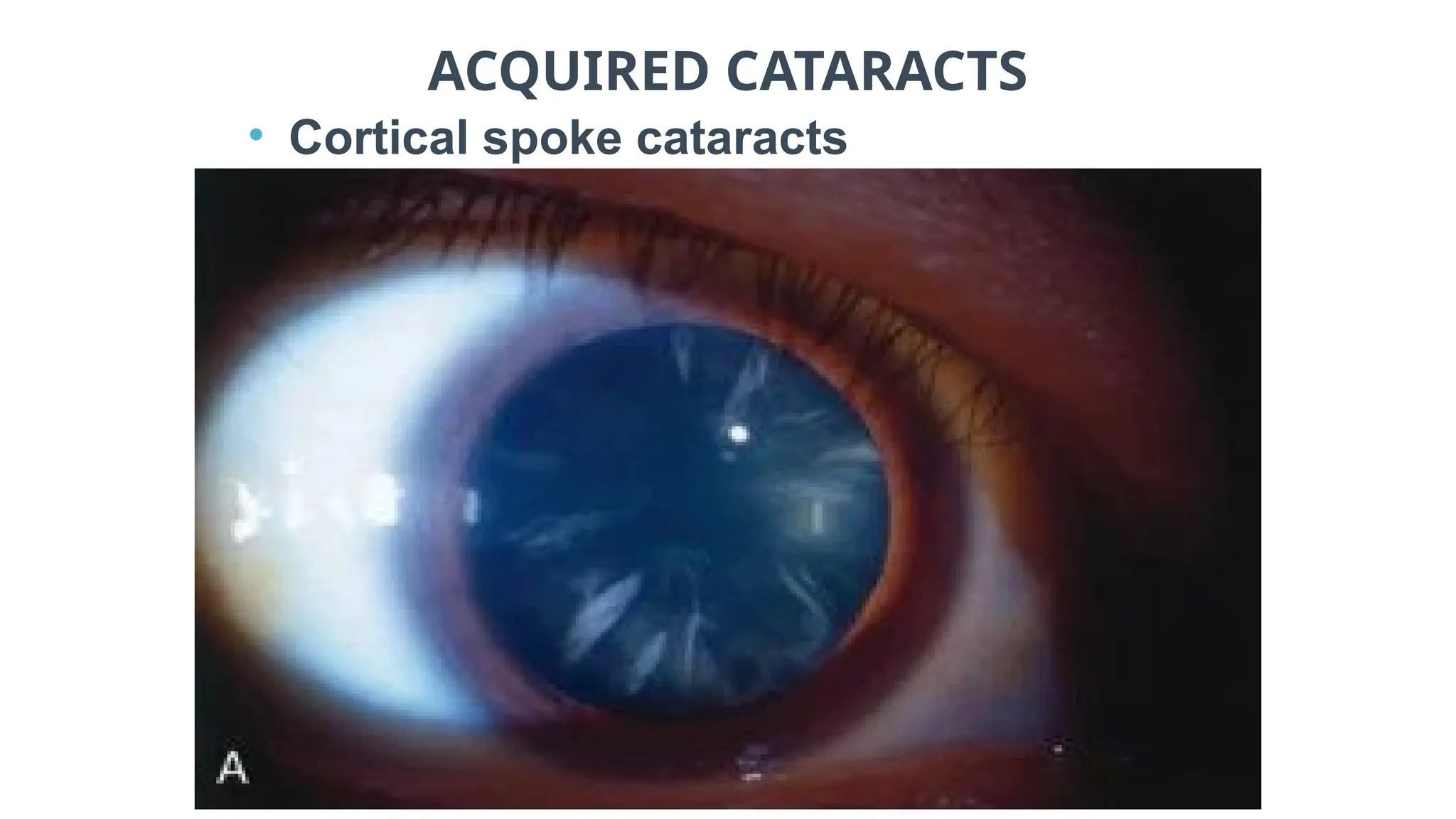 ACQUIRED CATARACTS
• Cortical spoke cataracts
 