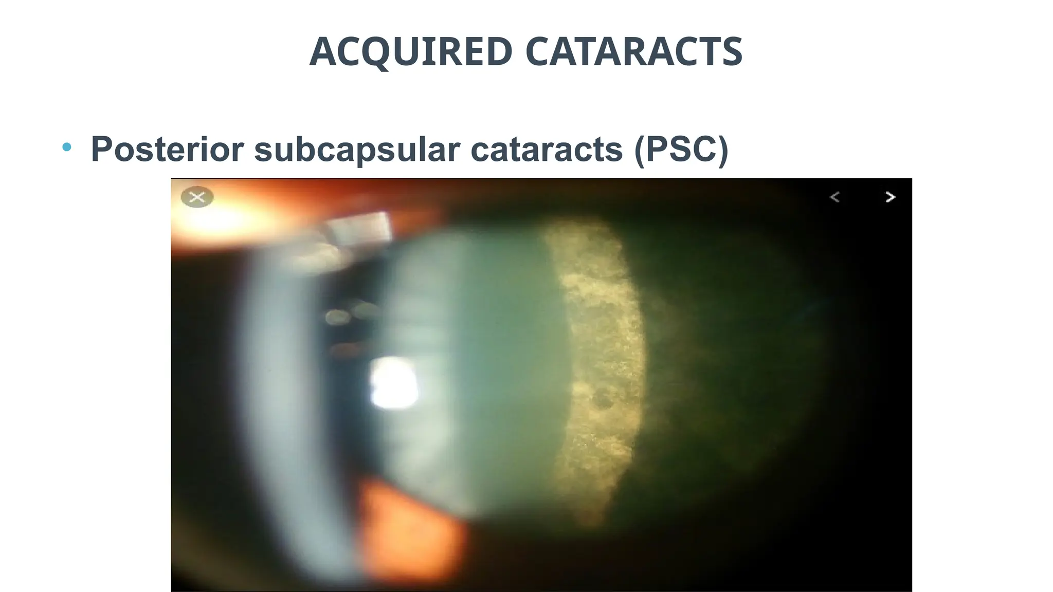 ACQUIRED CATARACTS
• Posterior subcapsular cataracts (PSC)
 