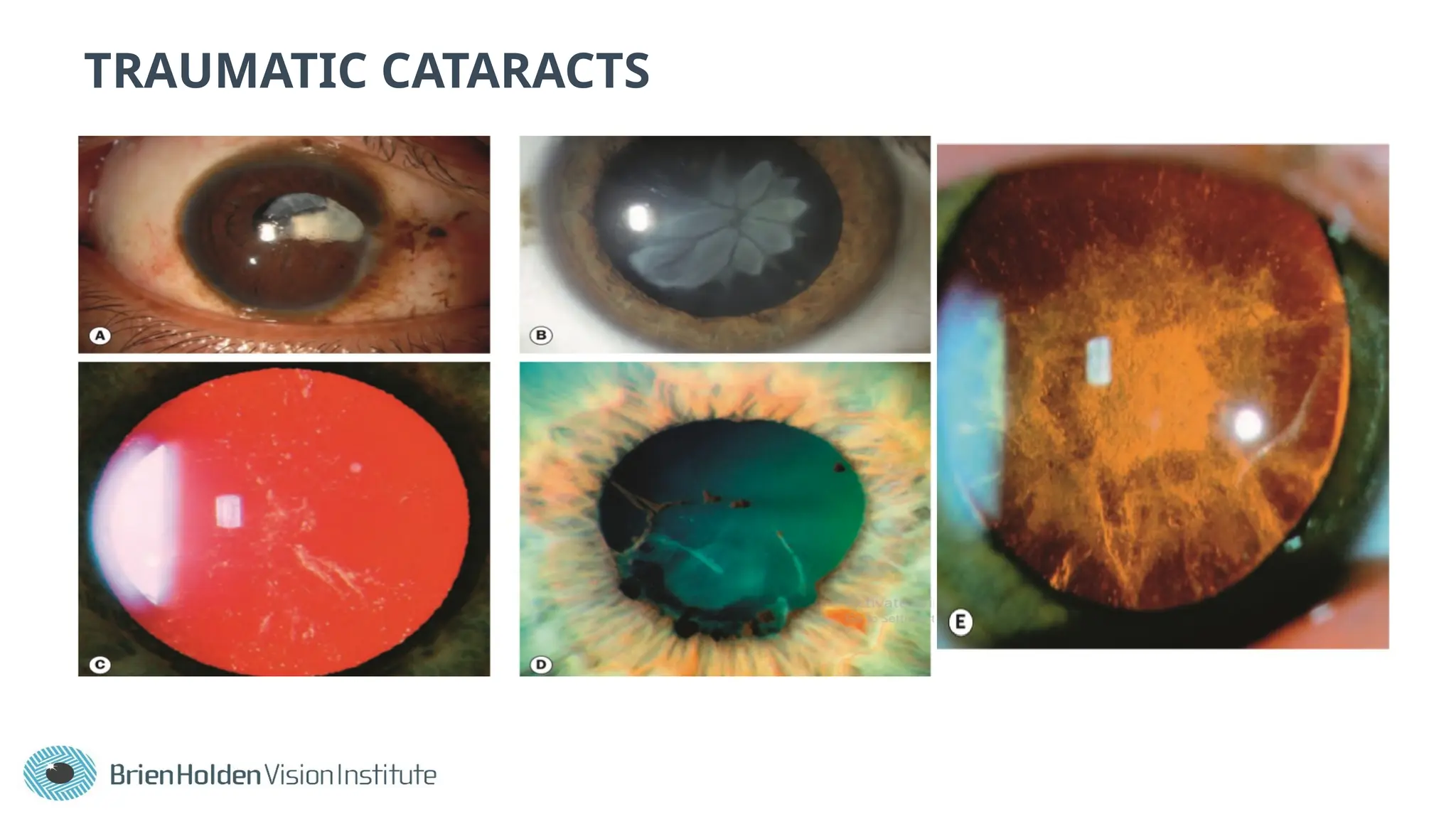 TRAUMATIC CATARACTS
 
