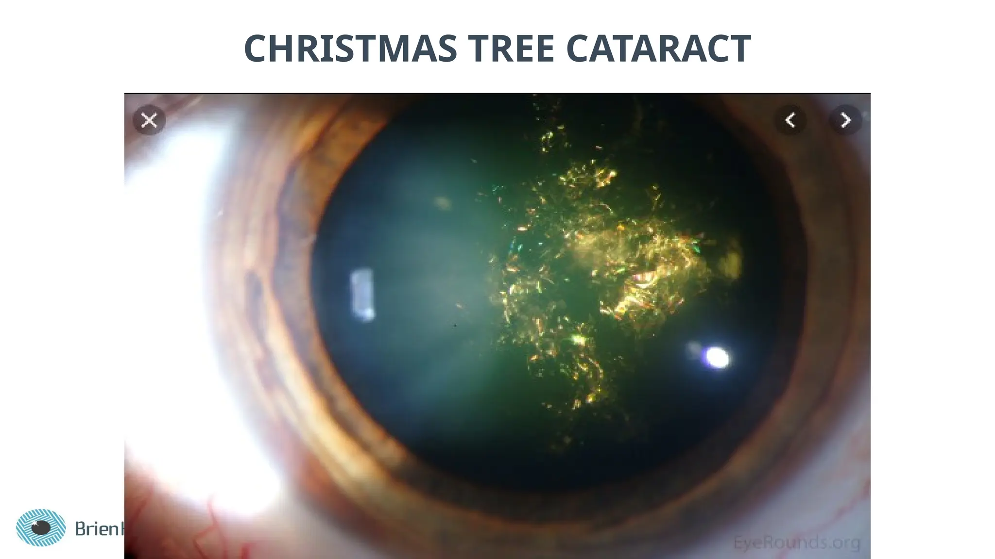 CHRISTMAS TREE CATARACT
 