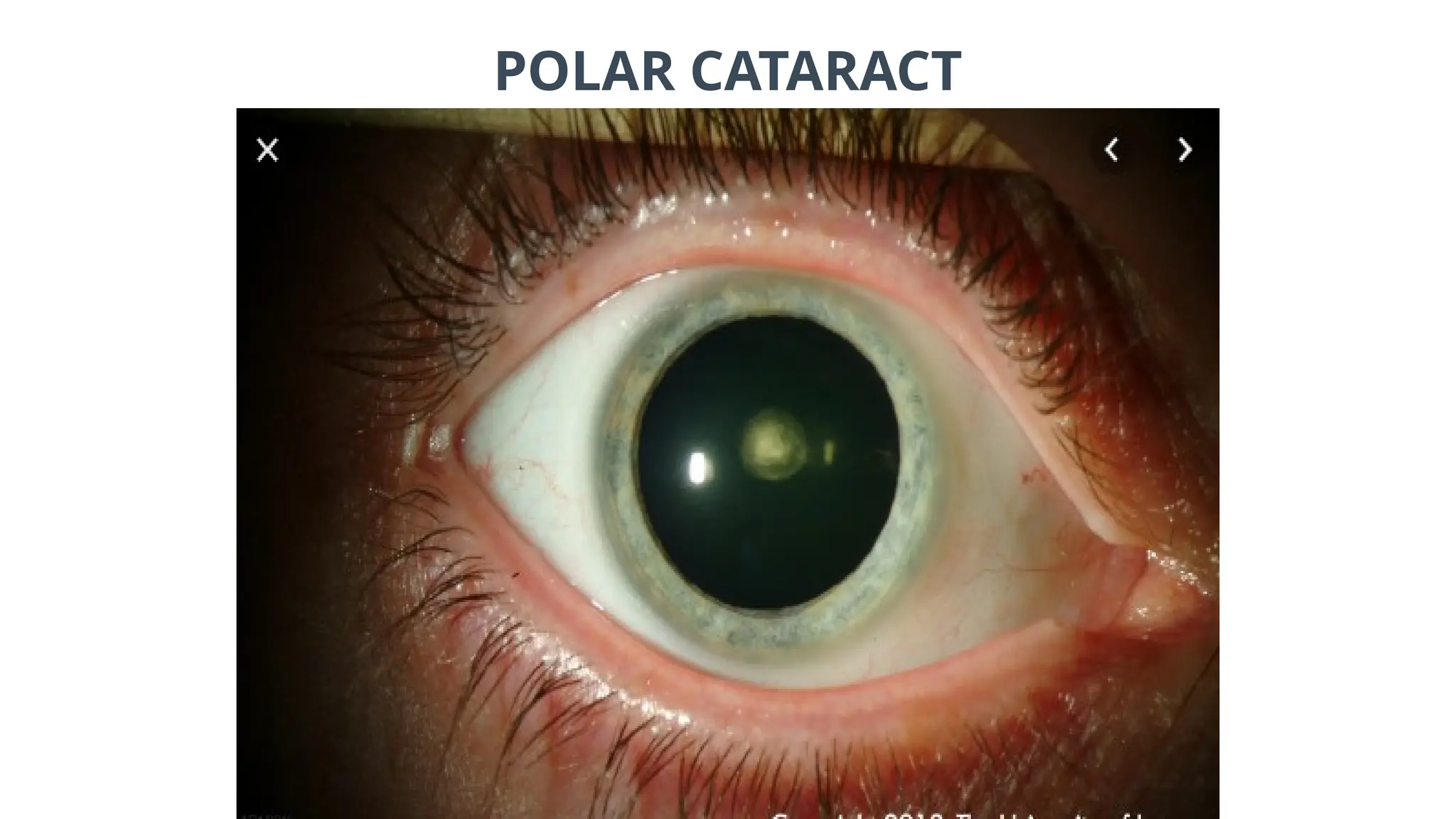 POLAR CATARACT
 