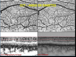 OCT – ANGIO EN DIABETES