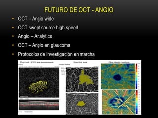 FUTURO DE OCT - ANGIO
• OCT – Angio wide
• OCT swept source high speed
• Angio – Analytics
• OCT – Angio en glaucoma
• Protocolos de investigación en marcha