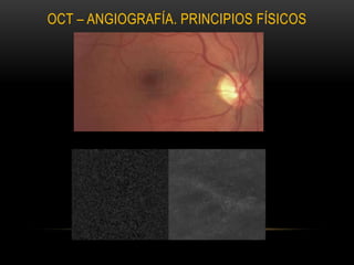 OCT – ANGIOGRAFÍA. PRINCIPIOS FÍSICOS