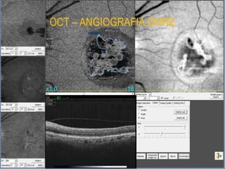 OCT – ANGIOGRAFIA DMRE
