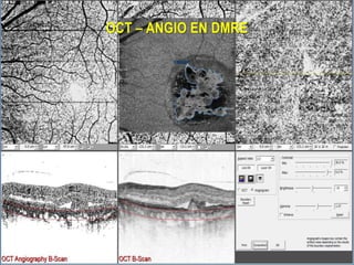 OCT – ANGIO EN DMRE