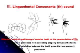 Effects of vertical positioning of anterior teeth on the pronunciation of th.
A. The tongue is prevented from extending properly between the teeth.
B. The tongue extending between the teeth when they are properly
positioned
III. Linguodental Consonants (th) sound
 