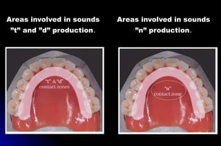 Areas involved in sounds
”t” and ”d” production.
Areas involved in sounds
”n” production.
 