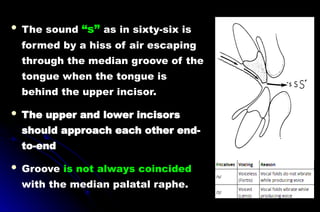  The sound “s” as in sixty-six is
formed by a hiss of air escaping
through the median groove of the
tongue when the tongue is
behind the upper incisor.
 The upper and lower incisors
should approach each other end-
to-end
 Groove is not always coincided
with the median palatal raphe.
 