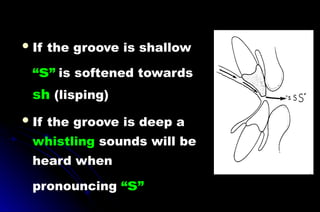 If the groove is shallow
“s” is softened towards
sh (lisping)
If the groove is deep a
whistling sounds will be
heard when
pronouncing “s”
 