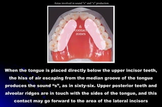 When the tongue is placed directly below the upper incisor teeth,
the hiss of air escaping from the median groove of the tongue
produces the sound “s”, as in sixty-six. Upper posterior teeth and
alveolar ridges are in touch with the sides of the tongue, and this
contact may go forward to the area of the lateral incisors
Areas involved in sound “s” and “z” production.
 