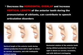  Decrease the HORIZONTAL OVERLAP and increase
VERTICAL LENGTH of the anterior teeth during the
pronunciation of sibilants, can contribute to speech
articulation disorders
Vertical length of the anterior teeth during
sibilant production from left to right is shown
as correct, excessive, and with inadequate
vertical overlap
Horizontal relation of the anterior teeth
during sibilant production from left to
right is shown as correct, excessive,
and with deficient overlapping
 