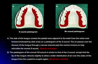 A, The side of the tongue contact the palatal area adjacent to the teeth from the molar area
forward (indicated by dark area) on a palatogram of the S sound. The air passes over the
dorsum of the tongue through a narrow channel past the central incisors to help
articulate the normal S sound. (Narrow and deep)
B, The palatogram of the normal SH sound is similar to that of the S sound, except that the
tip of the tongue retracts slightly to allow a wider distribution of air over the sides of the
tongue from the cuspid-to-cuspid region. (Broad and shallow)
Sh sound palatogram
S sound palatogram
A B
 