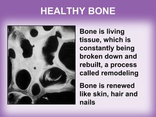 HEALTHY BONE
Bone is living
tissue, which is
constantly being
broken down and
rebuilt, a process
called remodeling
Bone is renewed
like skin, hair and
nails
 