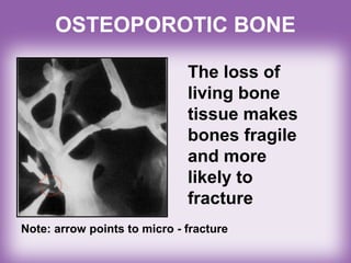 OSTEOPOROTIC BONE
The loss of
living bone
tissue makes
bones fragile
and more
likely to
fracture
Note: arrow points to micro - fracture
 