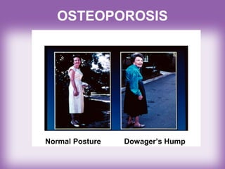 OSTEOPOROSIS
Normal Posture Dowager’s Hump
 