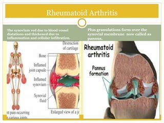 The synovium red due to blood vessel
diatations and thickened due to
inflammation and cellular infiltration.
Plus granulations form over the
synovial membrane now called as
pannus.
Rheumatoid Arthritis
 