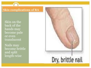 Skin complications of RASkin complications of RA
Skin on the
back of the
hands may
become pale
or even
translucent
Nails may
become brittle
and split
length-wise
 
