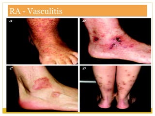 RA - VasculitisRA - Vasculitis
 