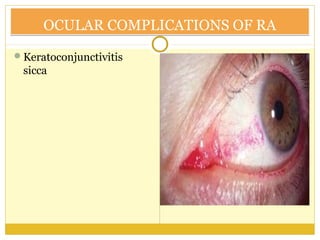 OCULAR COMPLICATIONS OF RAOCULAR COMPLICATIONS OF RA
Keratoconjunctivitis
sicca
 
