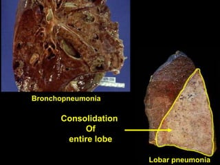 Spr 09 10Fall 07 10
Consolidation
Of
entire lobe
Patchy areas
of
consolidation
Lobar pneumonia
Bronchopneumonia
 