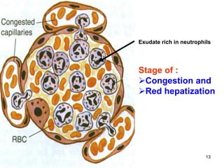 Spr 09 13Fall 07 13
Stage of :
Congestion and
Red hepatization
Exudate rich in neutrophils
 