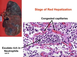 Spr 09 14Fall 07 14
Stage of Red Hepatization
Exudate rich in
Neutrophils
Congested capillaries
 