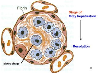 Spr 09 15Fall 07 15
Macrophage
Stage of :
Grey hepatization
Resolution
 
