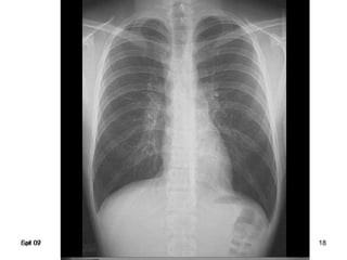 Spr 09 18Fall 07 18
Complete
right upper lobe
consolidation
Lobar pneumonia
 