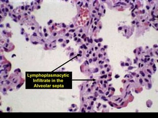 Spr 09 30Fall 07 30
Lymphoplasmacytic
Infiltrate in the
Alveolar septa
 