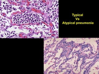 Spr 09 31Fall 07 31
Typical
Vs
Atypical pneumonia
 