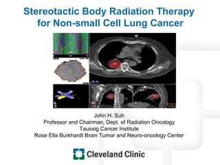 Stereotactic Body Radiation Therapy
   for Non-small Cell Lung Cancer




                          John H. Suh
     Professor and Chairman, Dept. of Radiation Oncology
                   Taussig Cancer Institute
  Rose Ella Burkhardt Brain Tumor and Neuro-oncology Center
 